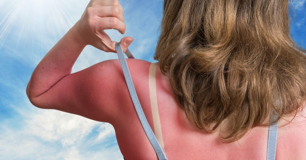 Une astuce aurait été trouvée pour éviter les coups de soleil